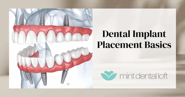 Dental Implant Placement Basics as a Step-by-Step Process