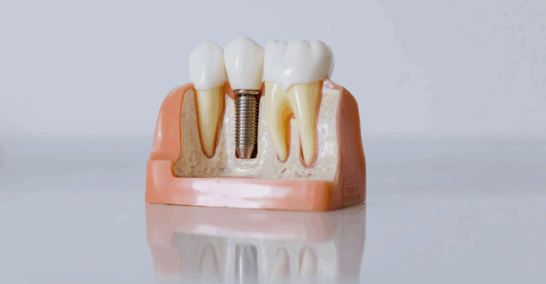 How Do I Care for My Dental Implants?