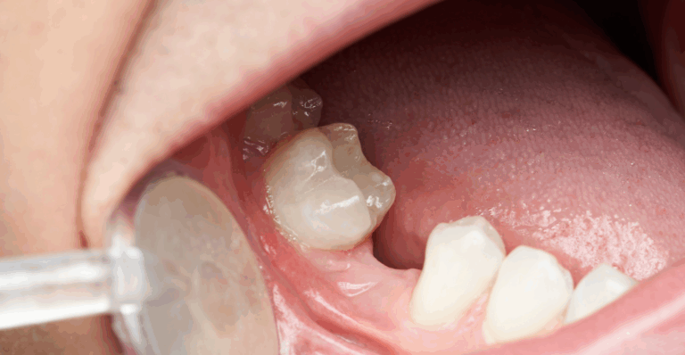 What Happens If I Don’t Replace a Missing Tooth?