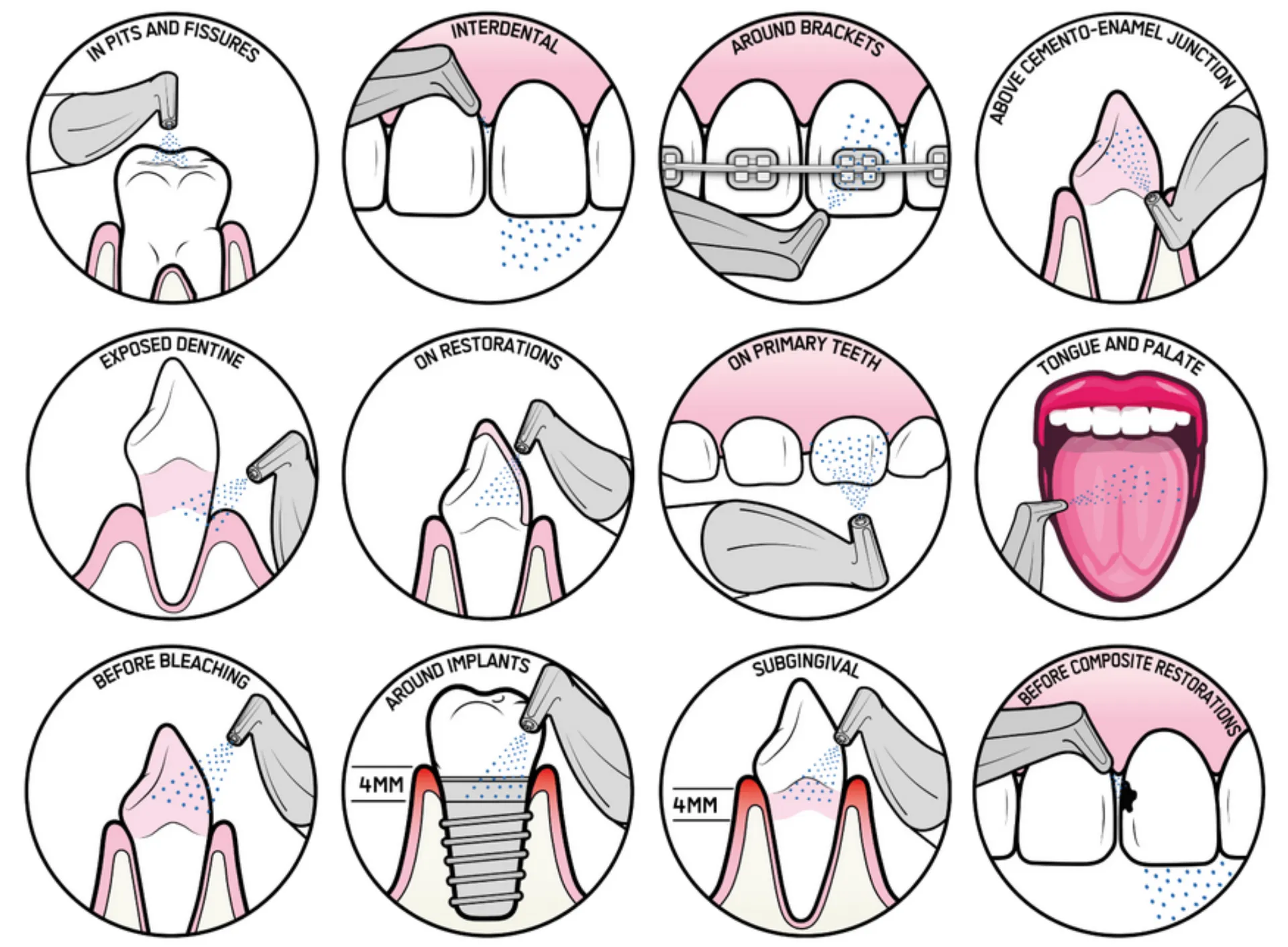 Areas cleaned during Guided Biofilm Therapy, including teeth, gums, and hard-to-reach surfaces